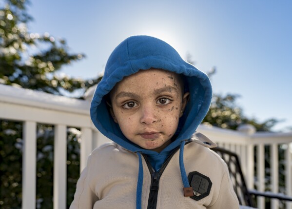 Omar Abu Kuwaik poses for a photo at the Global Medical Relief Fund residence, Wednesday, Jan. 17, 2024, in the Staten Island borough of New York. On Dec. 6, 2023 two Israeli airstrikes slammed into Omar's grandparents' home in the Nuseirat refugee camp, in central Gaza. The explosion peeled the skin from his face, exposing raw pink layers peppered with deep lacerations. His left arm could not be saved below the elbow. His parents, 6-year-old sister, grandparents, two aunts and a cousin were killed. (AP Photo/Peter K. Afriyie)