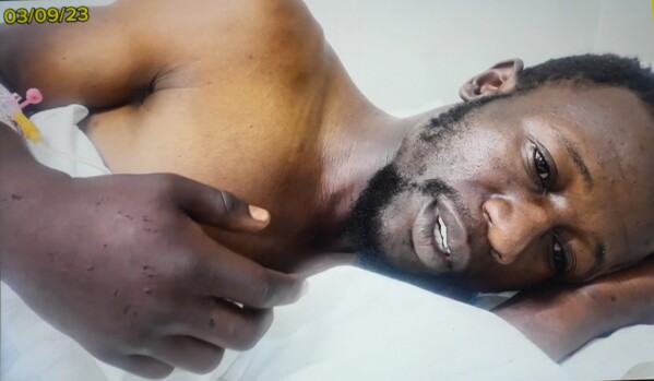 This photo provided by an anonymous source shows local councilor for Zimbabwe's main opposition party, Womberaiishe Nhende lying on a hospital bed in Harare, Sunday Sept. 3, 2023. Barely a week after being elected as a local councilor for Zimbabwe's main opposition party, Womberaiishe Nhende and a relative were pulled out of their car by unidentified men, shot with a stun gun and handcuffed. They were then bundled into a pickup truck and driven about 70 kilometers (more than 40 miles) outside of Harare, the capital, where they were whipped, beaten with truncheons and interrogated, and injected with an unknown substance, their lawyers say. (UGC Via AP)