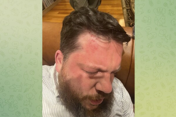 This image provided by Navalny Team on its Telegram channel shows the injuries sustained by Leonid Volkov, an ally and top strategist of the late opposition leader Alexei Navalny, after he was attacked near his home in Vilnius, Lithuania, on March 12, 2024. (Navalny Team via AP)