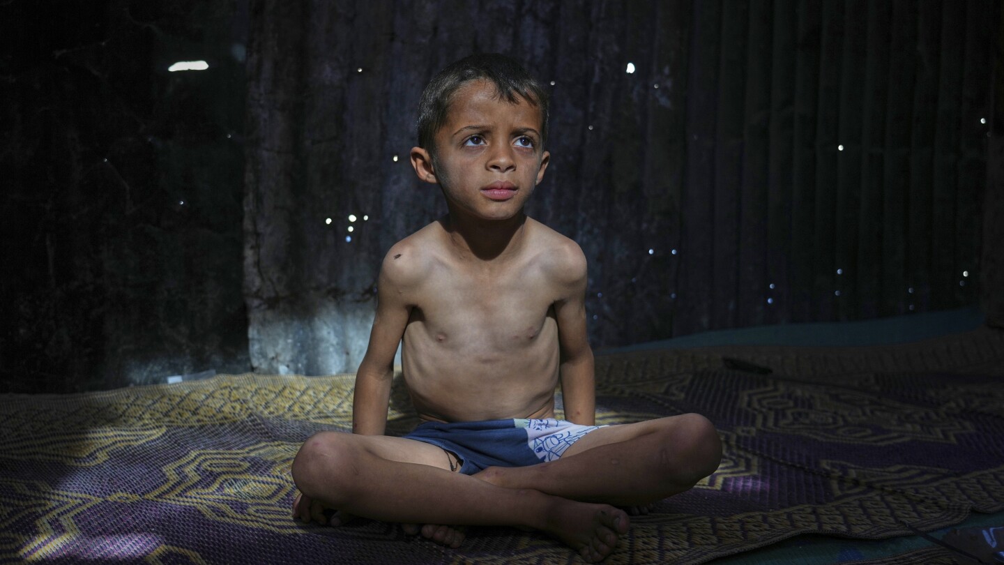 AP PHOTOS: Many in Gaza face malnutrition and hunger as blockade enters its third month