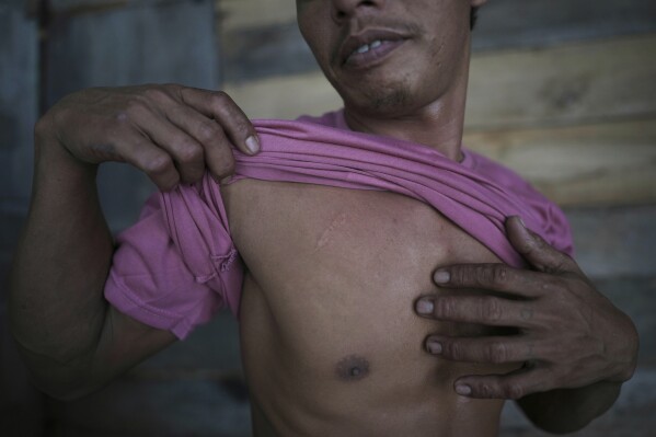 Suardi, a crocodile attack survivor, shows a scar on his chest in Budong-Budong, West Sulawesi, Indonesia, Monday, Feb. 24, 2025. (AP Photo/Dita Alangkara)