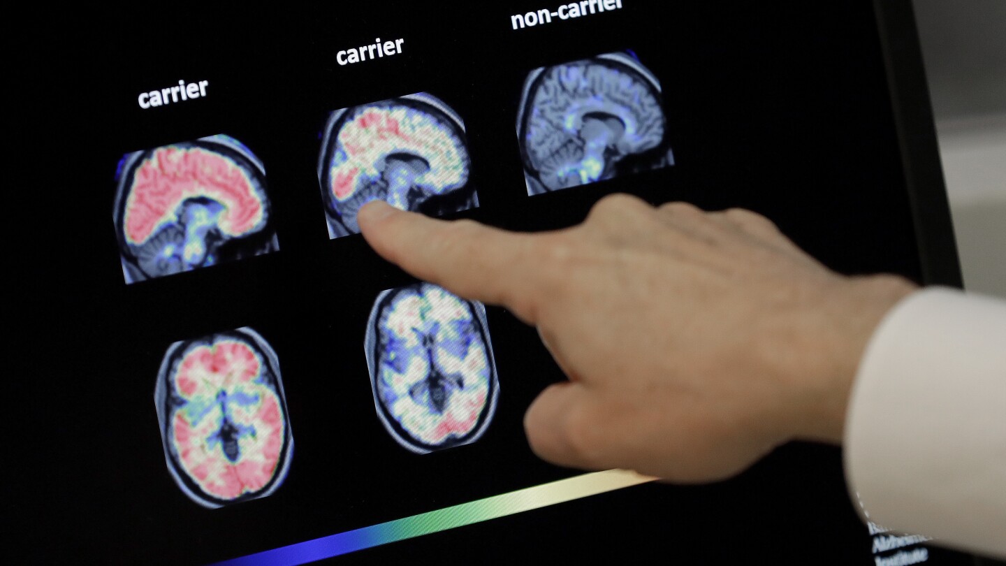 Shingles is awful, but there may be another reason to get vaccinated. It may fight dementia