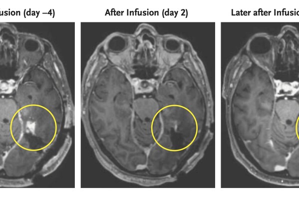 This combination of MRI scan images provided by the New England Journal of Medicine in March 2024 shows the progress of a glioblastoma patient who received CAR-T therapy which uses modified versions of T cells from a patient's own immune system. Studies published by the New England Journal of Medicine on Wednesday, March 13, 2024, signals a new strategy to fight glioblastoma by turning immune cells into “living drugs” that attack the brain cancer. (NEJM via AP)