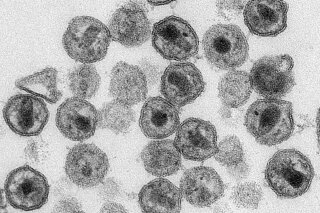 This 2011 electron microscope image made available by the Centers for Disease Control shows HIV virions. On Wednesday, Sept. 11, 2019, scientists are reporting the first use of the gene-editing tool CRISPR to try to cure a patient's HIV infection by providing blood cells that have been altered to resist the AIDS virus. (Maureen Metcalfe, Tom Hodge/CDC via AP)
