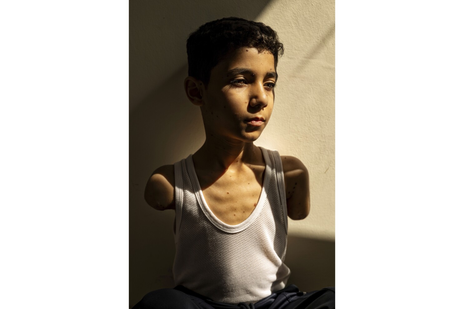 Portrait of Palestinian boy who lost both arms is World Press Photo of the  year for 2025 | AP News