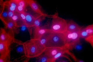 FILE - This undated fluorescence-colored microscope image made available by the National Institutes of Health in September 2016 shows a culture of human breast cancer cells. For the first time, one of the new immunotherapy drugs has shown promise against breast cancer in a large study that combined it with chemotherapy to treat an aggressive form of the disease. Results were discussed Saturday, Oct. 20, 2018 at a European Society for Medical Oncology conference in Munich and published by the New England Journal of Medicine. (Ewa Krawczyk/National Cancer Institute via AP)