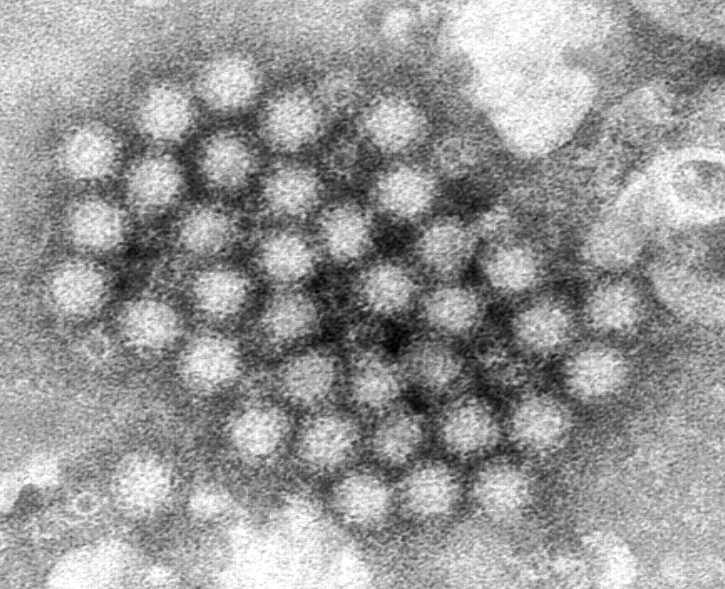 Norovirus cases are surging in the U.S., CDC data shows