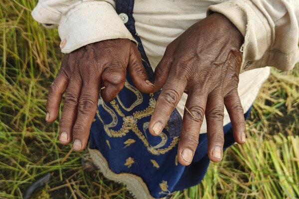 Savita Singh lost a finger to a chemical infection that she got after spraying pesticides and insecticides on a farm in Nanu town of Aligarh district in Uttar Pradesh state, India, on Oct. 17, 2023. (Uzmi Athar/Press Trust of India by means of AP)