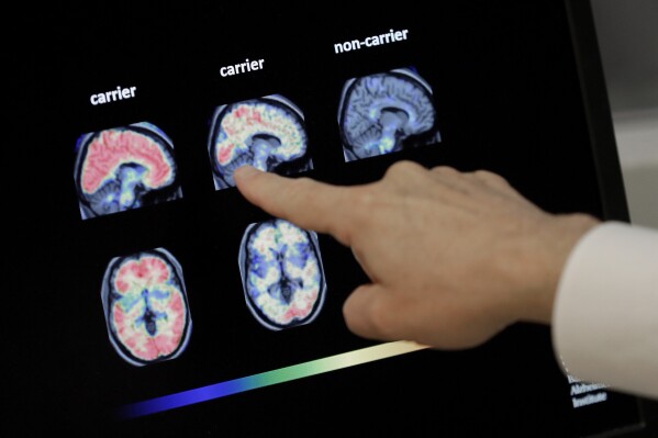 A doctor looks at PET brain scans at Banner Alzheimers Institute in Phoenix on Aug. 14, 2018. (AP Photo/Matt York, File)
