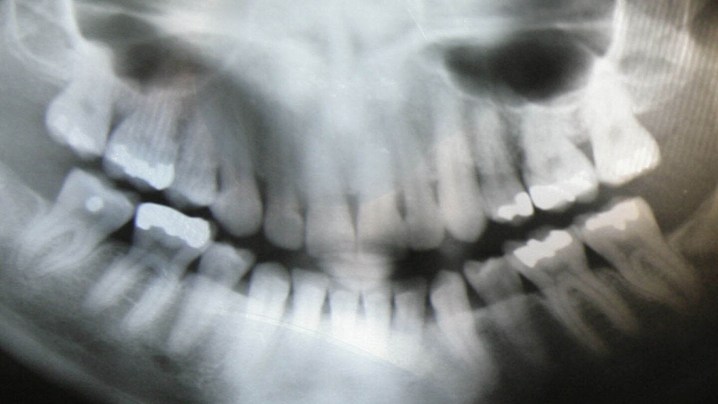 Получаване на рентгенова снимка на зъбите? Нова препоръка казва, че не се нуждаете от оловна престилка