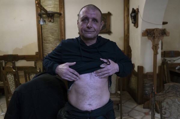 42-year-old Vyacheslav Ryabkov, an internally displaced person from Kozachi Laheri in the Kherson region of Ukraine, shows in Kolomyya on Feb. 13, 2024 the scars on his stomach caused by Russian soldiers who cut him with a knife. (AP Photo/Vasilisa Stepanenko)
