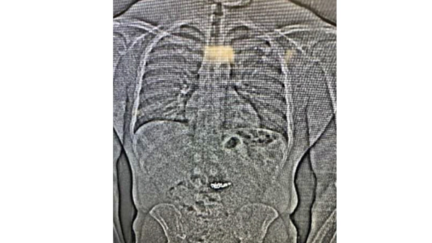 X-ray shows diamond earrings swallowed by theft suspect during arrest, police say