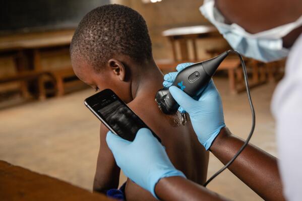 In partnership with Bridge to Health, Butterfly being used in Uganda (Photo: Business Wire)