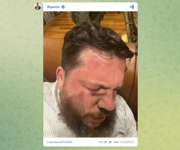 This image provided by Navalny Team on its Telegram channel shows the injuries sustained by Leonid Volkov, an ally and top strategist of the late opposition leader Alexei Navalny, after he was attacked near his home in Vilnius, Lithuania, on March 12, 2024. (Navalny Team via AP)