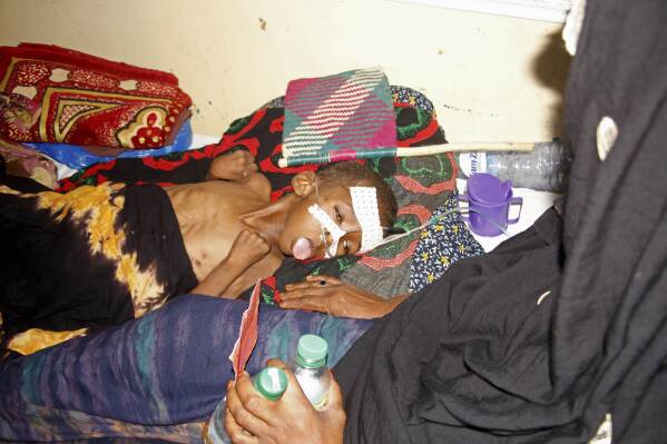 A woman checks on her malnourished child at Banadir Hospital in Mogadishu, Somalia, Wednesday, May 14, 2025. (AP Photo/Farah Abdi Warsameh)