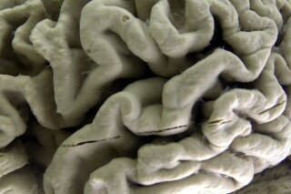 FILE - A closeup of a human brain affected by Alzheimer's disease, is displayed at the Museum of Neuroanatomy at the University at Buffalo in Buffalo, N.Y., on Oct. 7, 2003. According to findings published Wednesday, Feb. 21, 2024 in the New England Journal of Medicine, Alzheimer’s quietly ravages the brain long before symptoms appear and now scientists are getting a closer look at the domino-like sequence of those changes _ a potential window to one day intervene. (AP Photo/David Duprey)