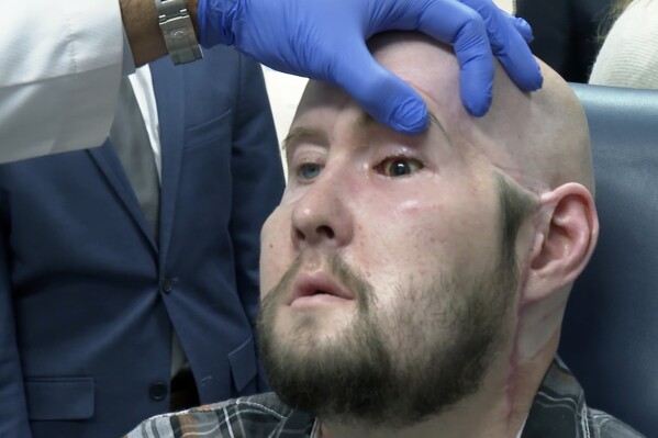 Dr. Eduardo Rodriguez, NYU Langone Health's chair of plastic surgery, examines Aaron James in New York on Oct. 23, 2023. In May 2023, surgeons performed the world’s first transplant of an entire human eye, an extraordinary addition to a face transplant _ although it’s far too soon to know if the man will ever see through his new left eye. “It feels good. I still don’t have any movement in it yet. My eyelid, I can’t blink yet. But I’m getting sensation now,” James said in October. (AP Photo/Joseph. B. Frederick)