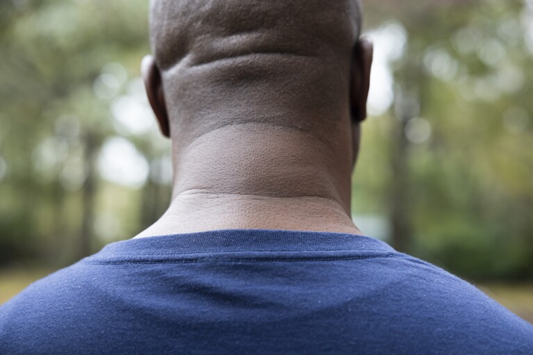 Former NFL player Boo Williams has a visibly swollen neck from an old football injury, Picayune, Miss., Wednesday, Nov. 15, 2023. (AP Photo/Christiana Botic)