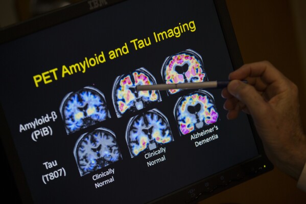 R. Scott Turner, Professor of Neurology and Director of the Memory Disorder Center at Georgetown University Hospital, points to PET scan results that are part of a study on Alzheimer's disease at Georgetown University Hospital in Washington, May 19, 2015. (AP Photo/Evan Vucci, File)