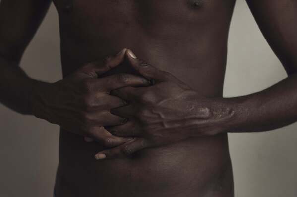 Abdoul, 32 year-old migrant from Maghama, Mauritania poses for a photograph showing surgery scars after treating injuries alleged inflicted by Mauritanian Police on Friday, Oct. 6, 2023, in New York. He spent weeks in a remote Texas jail on local trespassing charges after crossing the U.S.-Mexico border. "I spent a lot of hours without sleeping, sitting on the floor," said Abdoul, a political activist who fled Mauritania, fearing persecution. He spoke on the condition that his last name not be published for fear of jeopardizing his request for asylum. (AP Photo/Andres Kudacki)