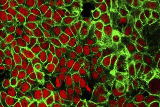 FILE - This microscope image made available by the National Cancer Institute Center for Cancer Research in 2015 shows human colon cancer cells with the nuclei stained red. Americans should start getting screened for colon cancer earlier, at age 45 instead of waiting until they're 50, according to new guidelines from the U.S. Preventive Services Task Force, released on Tuesday, May 18, 2021. (NCI Center for Cancer Research via AP, File)