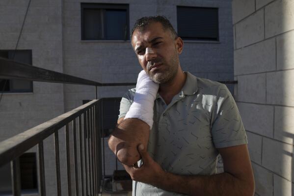 Yousef Adi, 36, shows his injuries at his apartment in the West Bank city of Ramallah, Sunday, Sept. 11, 2022. Adi, who is seen in an amateur video lying face down, bloody and motionless, as an Israeli policeman kneels on his neck, said Sunday that Israeli forces beat and detained him without provocation as he headed to pray at Jerusalem's chief Muslim shrine. (AP Photo/Nasser Nasser)