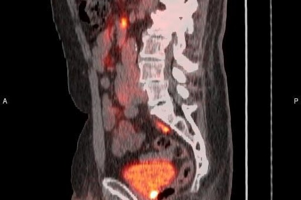 POSLUMA® (flotufolastat F 18) PET/CT image showing uptake in the prostate bed, consistent with recurrent prostate cancer Photo courtesy of Blue Earth Diagnostics