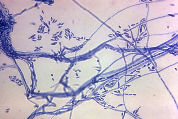 This microscope photo provided by the Centers for Disease Control and Prevention shows a Fusarium sp. fungal organism in 1972. The U.S. CDC says the death toll has risen to six in an outbreak of fungal meningitis tied to surgical procedures in a city along the U.S.-Mexico border, and they have not been able to reach everyone who may be at risk of infection. Labs have detected fungal signals consistent with Fusarium solani species complex from the cerebrospinal fluid of patients receiving follow-up care in Mexico or the United States. (Dr. Lucille K. Georg/CDC via AP)