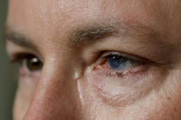 Phil Durst, who has undergone an experimental stem cell procedure with his eyes, sits for a portrait in Homewood, Ala., on Tuesday, Aug. 15, 2023. His left eye bore the brunt of a 2017 work accident, which stole his vision, left him unable to tolerate light and triggered four to five cluster headaches a day. (AP Photo/Butch Dill)