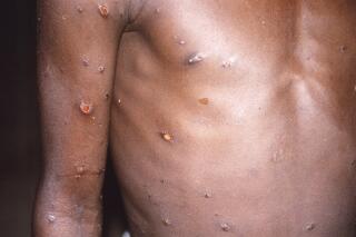 FILE - This 1997 image provided by U.S. Centers for Disease Control and Prevention shows the right arm and torso of a patient, whose skin displayed a number of lesions due to what had been an active case of monkeypox. As health authorities in Europe and elsewhere roll out vaccines and drugs to stamp out the biggest monkeypox outbreak beyond Africa, in 2022, some doctors are acknowledging an ugly reality: The resources to slow the disease's spread have long been available, just not to the Africans who have dealt with it for decades. (CDC via AP, File)