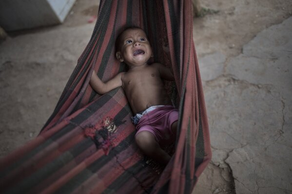 FILE - In this Nov. 25, 2019 file photo, Osmery Vargas, who is malnourished, cries in a hammock as she and her 7-year-old sister Yasmery Vargas wait for their mother to return from begging in the street for money and food in Maracaibo, Venezuela. Even before the coronavirus pandemic in 2020, inflation had rendered many salaries nearly worthless and forced millions to flee abroad. (AP Photo/Rodrigo Abd)