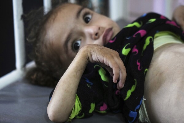 Mayar Al-Arja, 2, who suffers from malnutrition, lies on a bed in a clinic in Nasser hospital, Khan Younis, Gaza, Wednesday, May 21, 2025. (AP Photo/Abdel Kareem Hana)