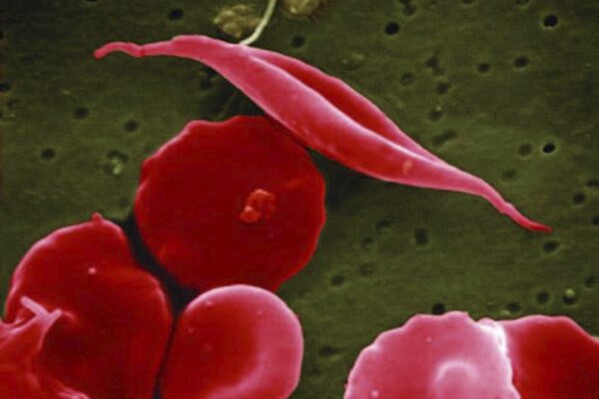 This electron microscope image provided by the National Institutes of Health in 2016 shows a blood cell altered by sickle cell disease. (National Center for Advancing Translational Sciences (NCATS), National Institutes of Health via AP)