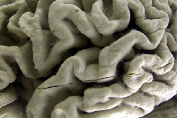 FILE - A closeup of a human brain affected by Alzheimer's disease, is displayed at the Museum of Neuroanatomy at the University at Buffalo in Buffalo, N.Y., on Oct. 7, 2003. According to findings published Wednesday, Feb. 21, 2024 in the New England Journal of Medicine, Alzheimer鈥檚 quietly ravages the brain long before symptoms appear and now scientists are getting a closer look at the domino-like sequence of those changes _ a potential window to one day intervene. (AP Photo/David Duprey)