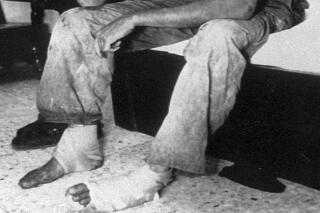 American journalist Nate Thayer, of Falmouth, Mass., sits bandaged in a hotel room on Oct. 15, 1989 in Aranyaprathet, Thailand, after he was injured in a land mine explosion on his return from Cambodia. Thayer, a fearless reporter who survived several brushes with death over decades covering conflict in Southeast Asia, was the last western journalist to interview Pol Pot, the leader of the murderous Khmer Rouge regime in Cambodia. Thayer was found dead at his Falmouth, Massachusetts home on Tuesday by a friend, his brother, Rob Thayer, said Thursday, Jan. 5, 2023. (AP Photo)