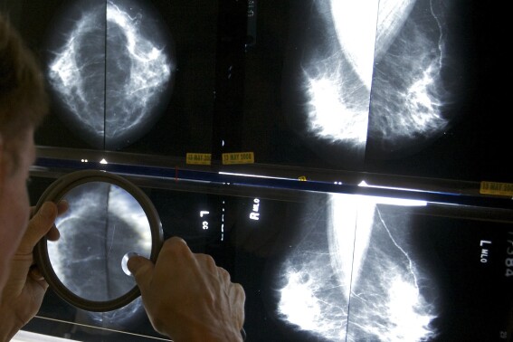 FILE - A radiologist uses a magnifying glass to check mammograms for breast cancer in Los Angeles, May 6, 2010. Annual mammograms are now recommended indefinitely for breast cancer survivors in many countries including the United States. Now a large British study finds that less frequent screening is just as good. The findings were being discussed Friday, Dec. 8, 2023 at the San Antonio Breast Cancer Symposium. (AP Photo/Damian Dovarganes, File)