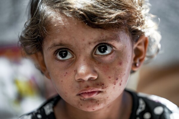 Displaced child Toleen Marshoud, who suffers from skin disease, sits at a makeshift tent camp in Deir al-Balah, central Gaza Strip, Monday, July 29, 2024. (AP Photo/Abdel Kareem Hana )