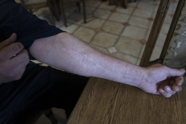 42-year-old Vyacheslav Ryabkov, an internally displaced person from Kozachi Laheri in the Kherson region of Ukraine, shows in Kolomyya on Feb. 13, 2024 the scars on his arms caused by Russian soldiers who cut him with a knife. (AP Photo/Vasilisa Stepanenko)